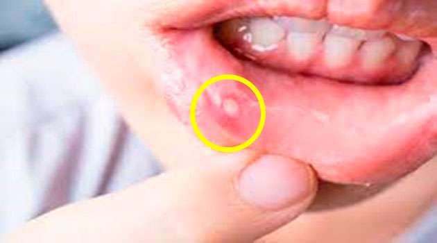 Mouth Ulcer in telugu