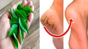 Home remedies for cracked heels In Telugu