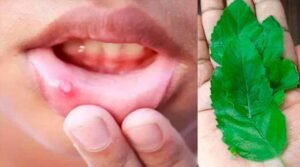Mouth ulcer Home Remedies