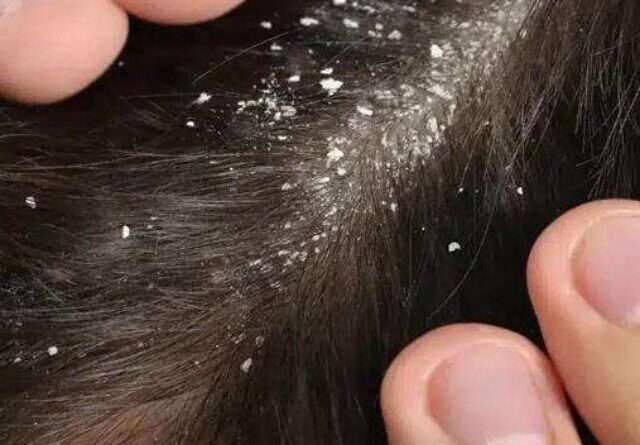 cropped-dandruff.jpg